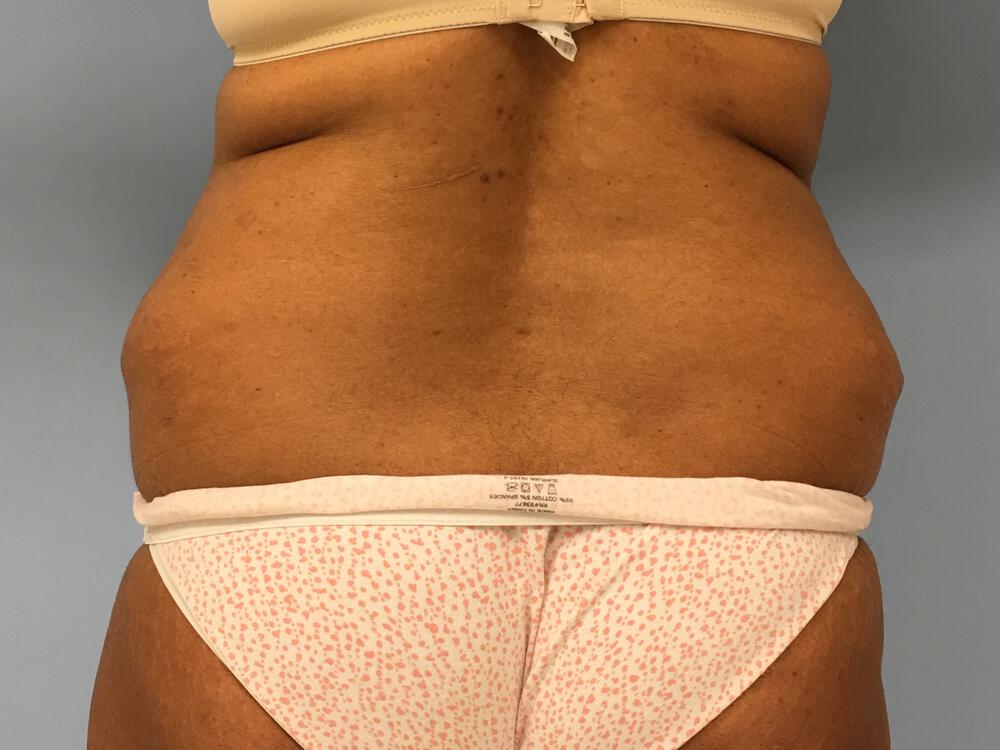 Revision Tummy Tuck Before & After Image
