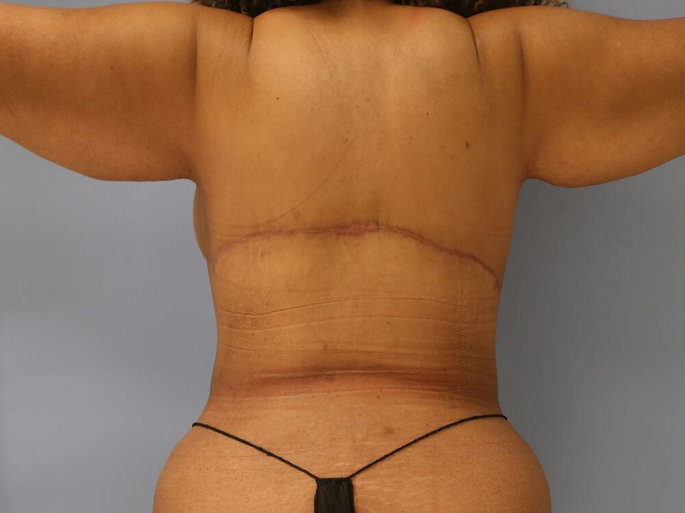 Bra-Line-Back-Lift, Photo Gallery, Before & After