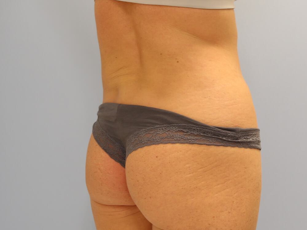 Buttocks Implants Before & After Image