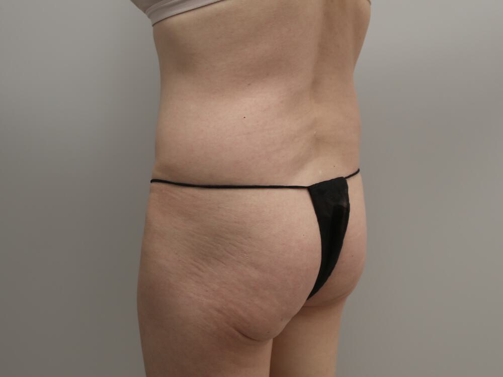 Buttocks Implants Before & After Image