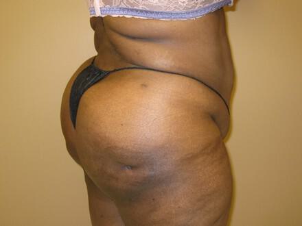 Buttocks Reshaping Before & After Image