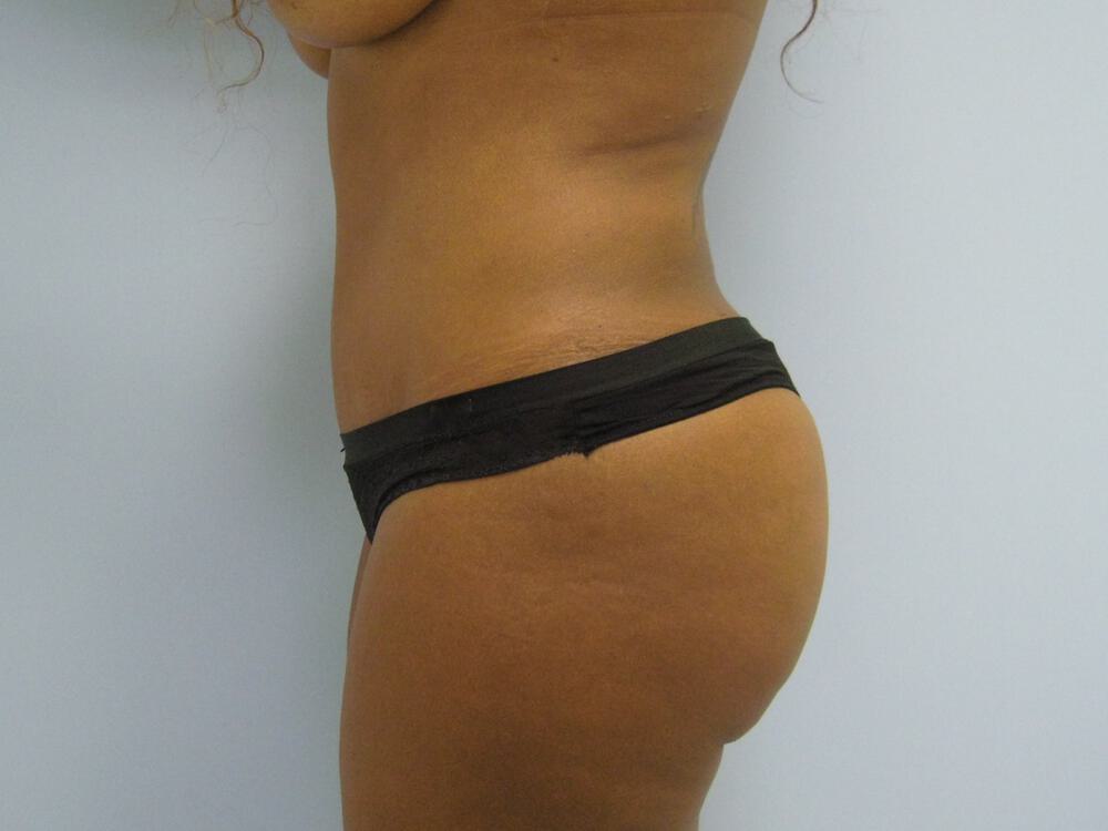Buttocks Reshaping Before & After Image