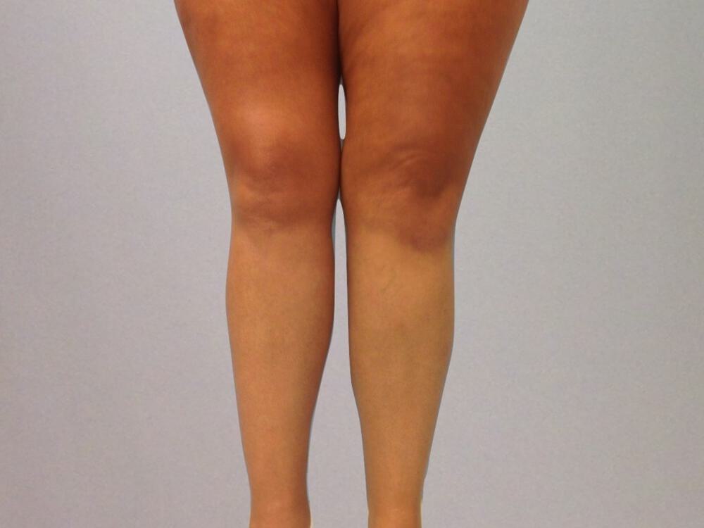 Calf Implants Before & After Image