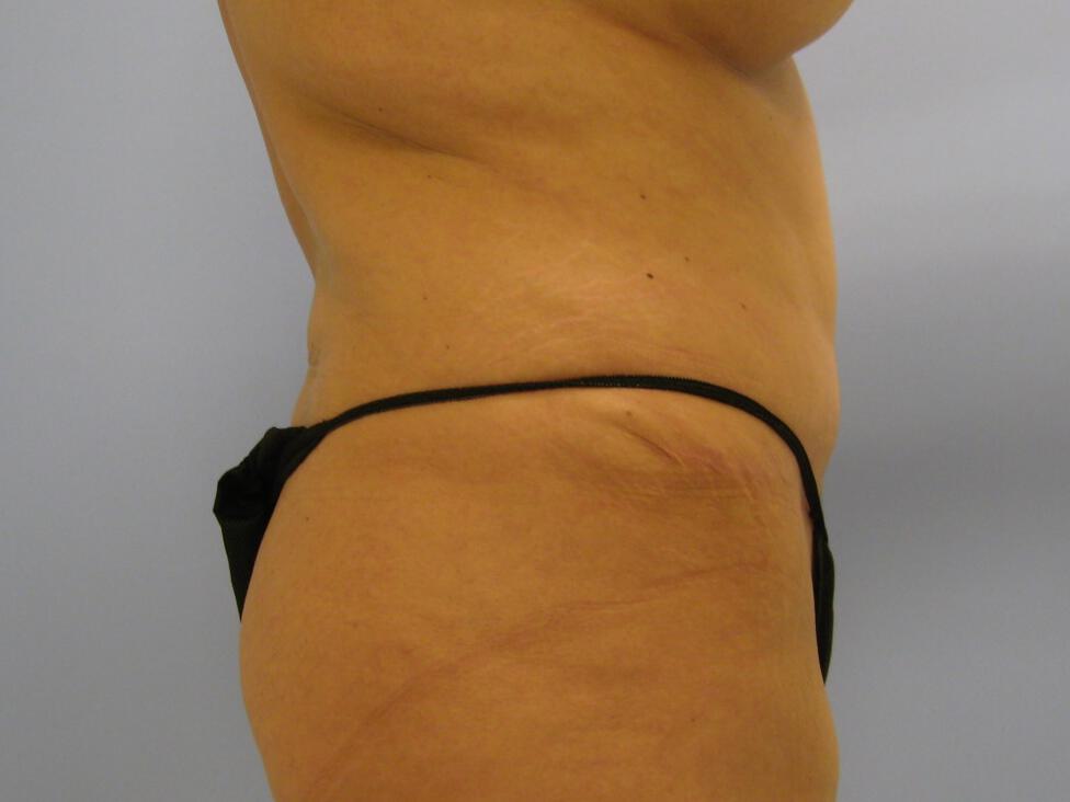 Revision Tummy Tuck Before & After Image