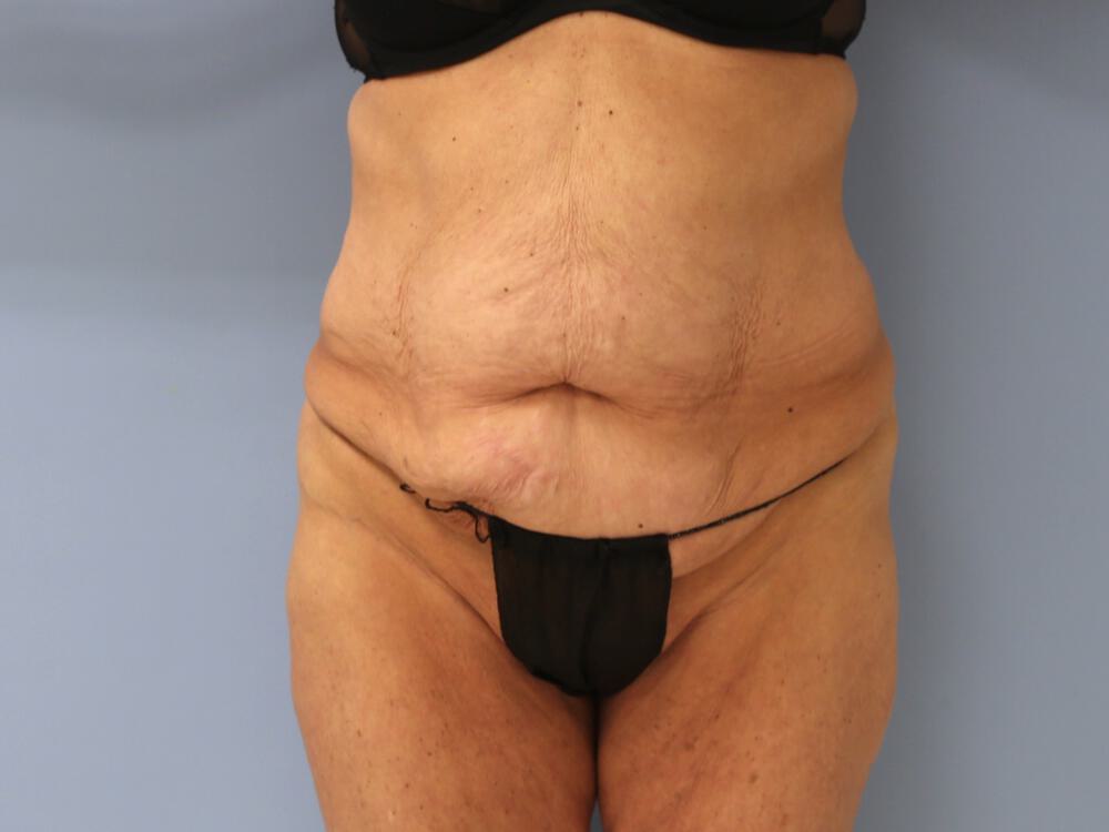 Surgery After Weight Loss Before & After Image