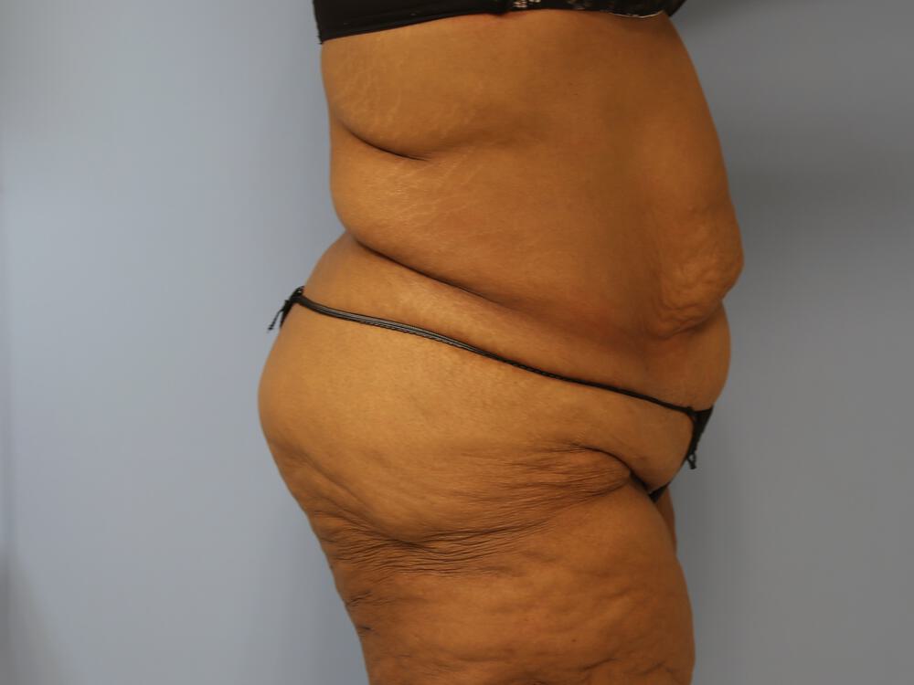 Surgery After Weight Loss Before & After Image