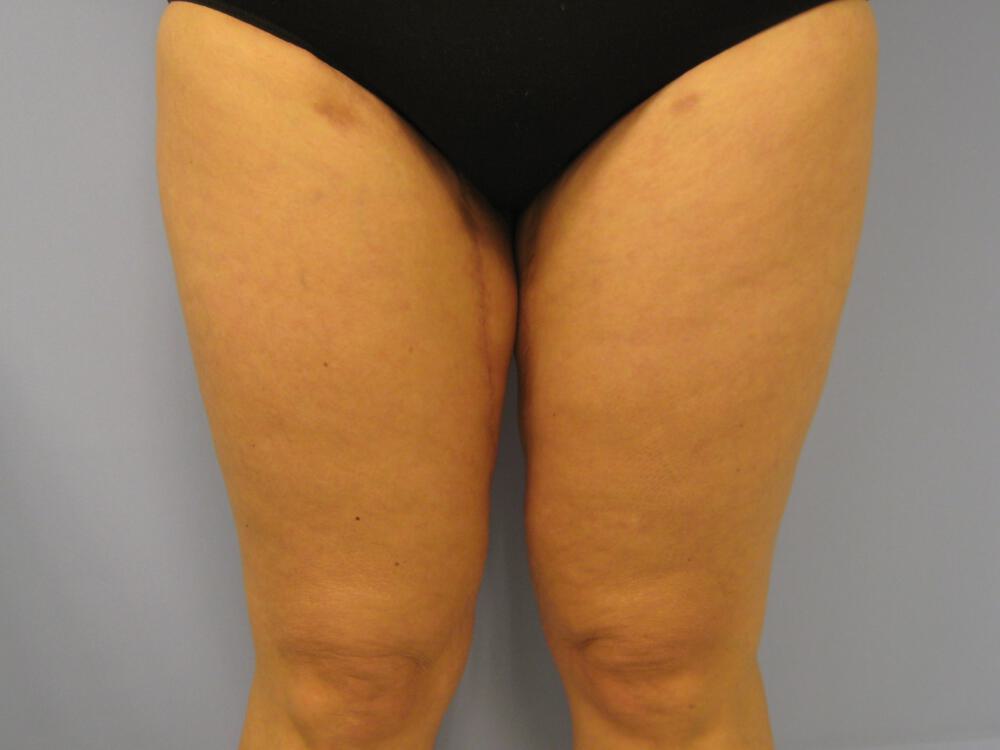 Thigh Lift Before & After Image