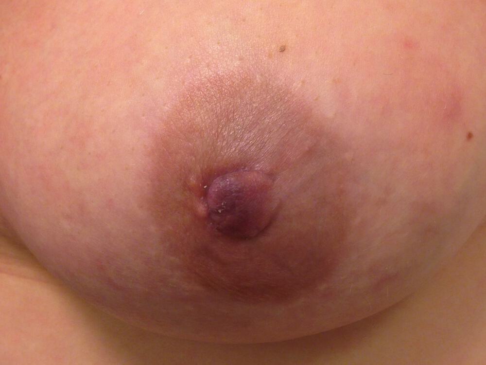Nipple Areola Surgery Before & After Image