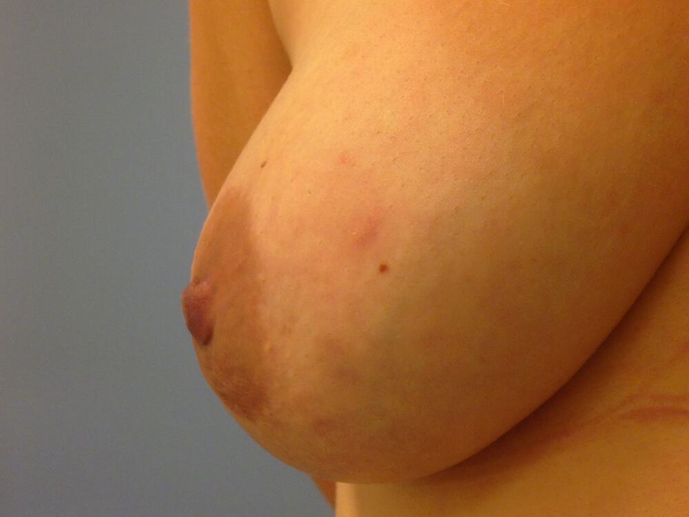 Nipple Areola Surgery Before & After Image