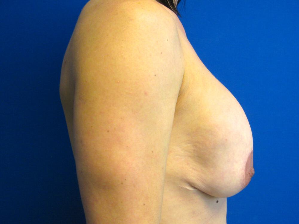 Revision Breast Surgery Before & After Image