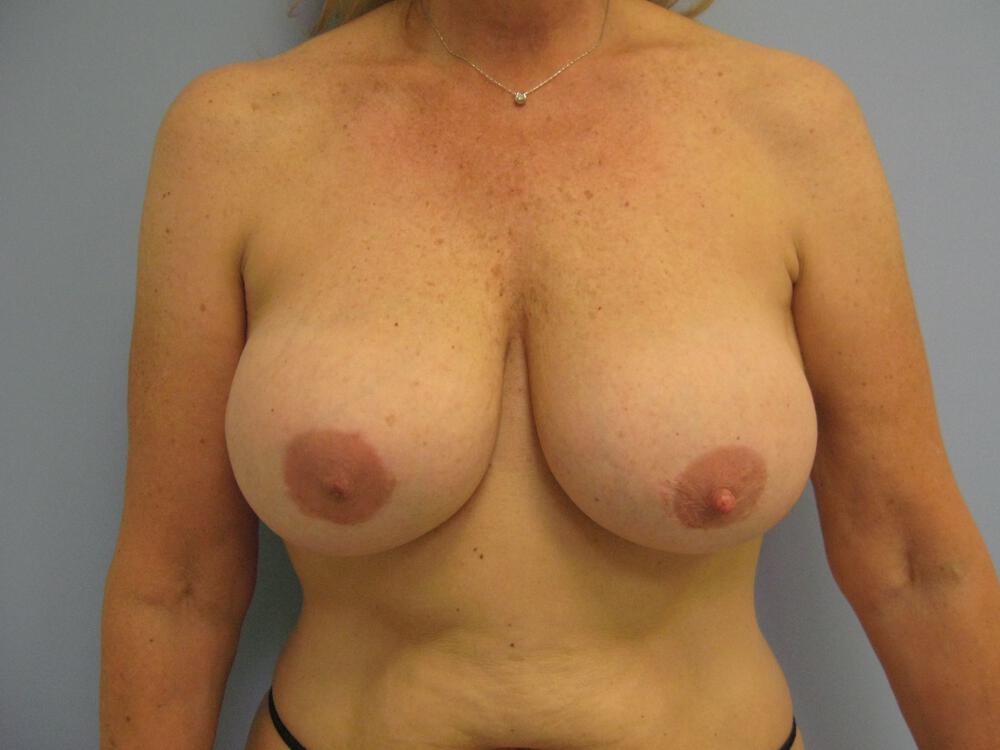 Revision Breast Surgery Before & After Image