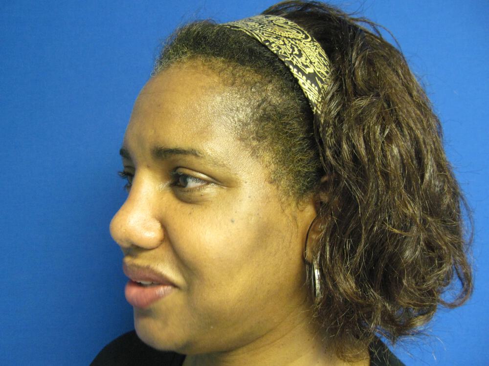 African American Rhinoplasty Before & After Image