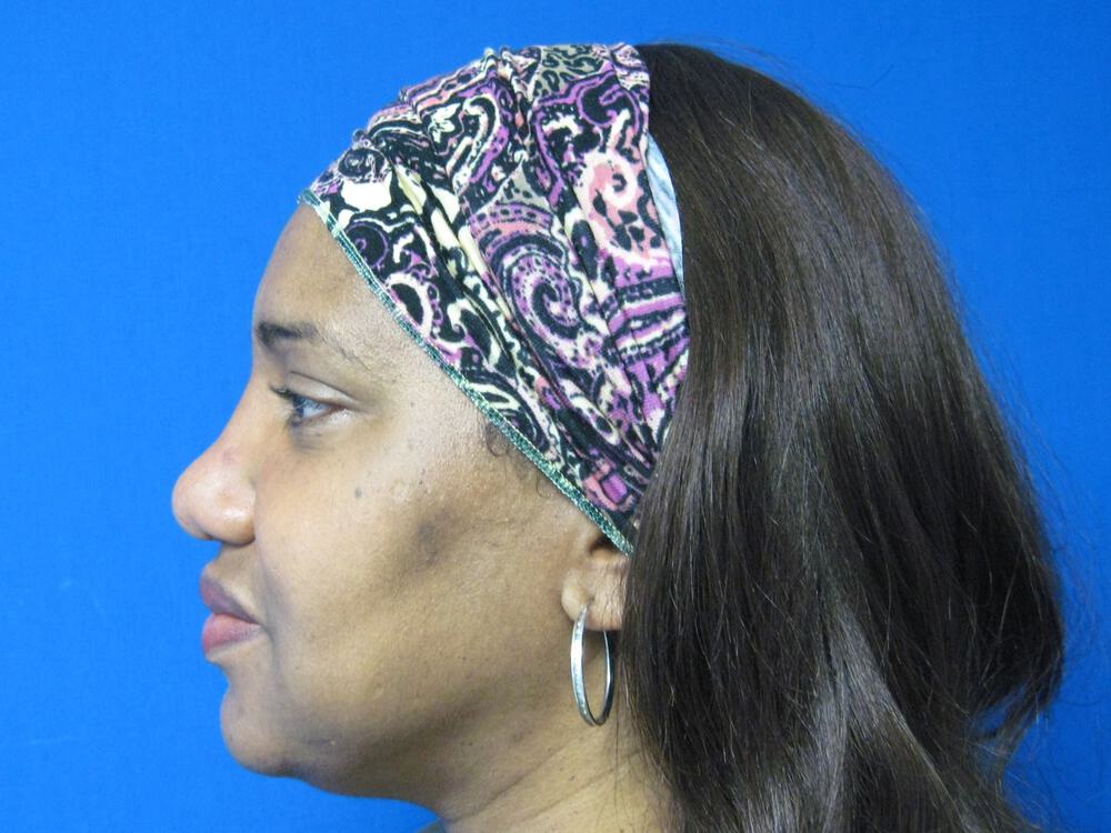 African American Rhinoplasty Before & After Image