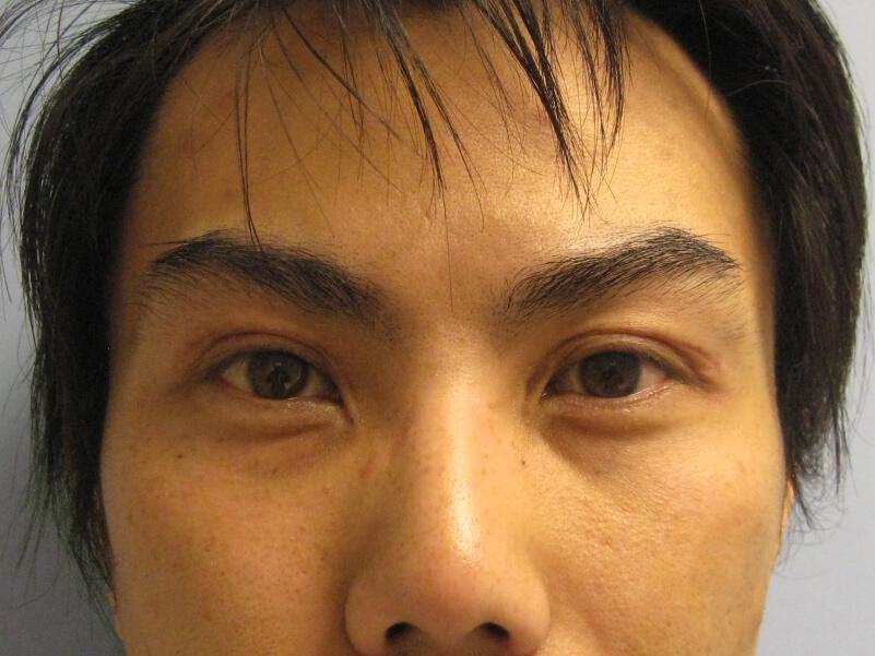 Asian Eyelid Surgery Before & After Image