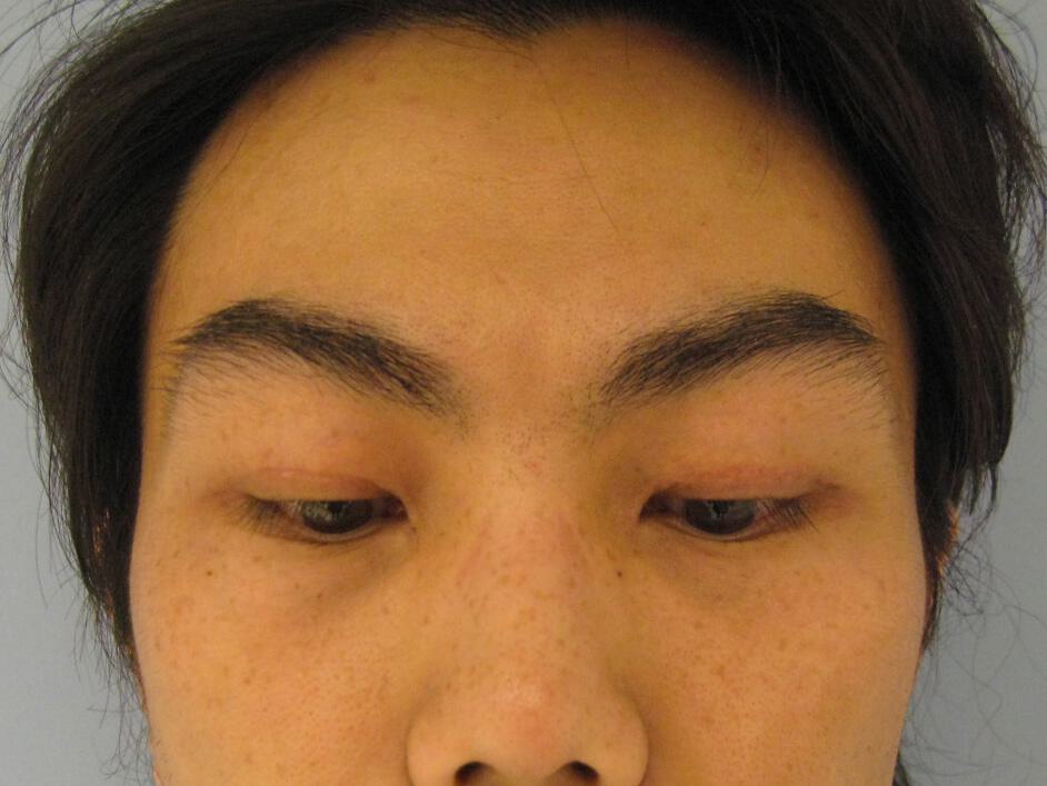 Asian Eyelid Surgery Before & After Image