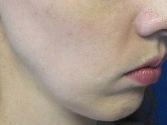 Chin Surgery Before & After Image