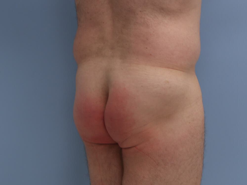 Male Butt Implants Before & After Image