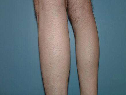 Male Calf Implants Before & After Image