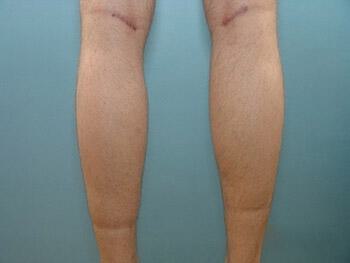 Male Calf Implants Before & After Image