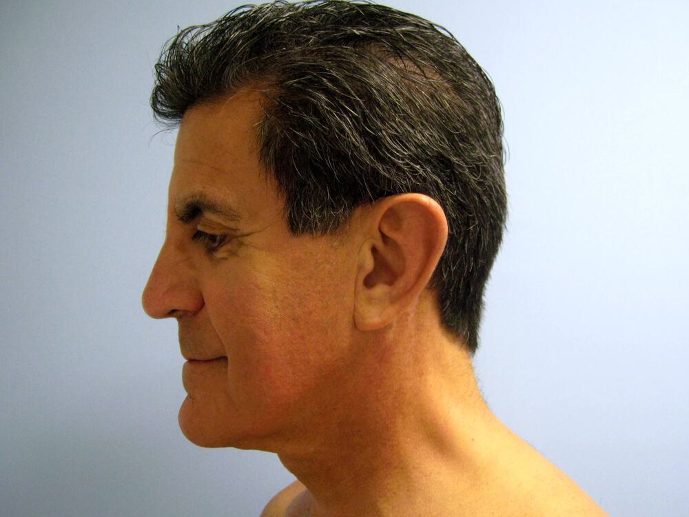 Male Facial Surgery Before & After Image