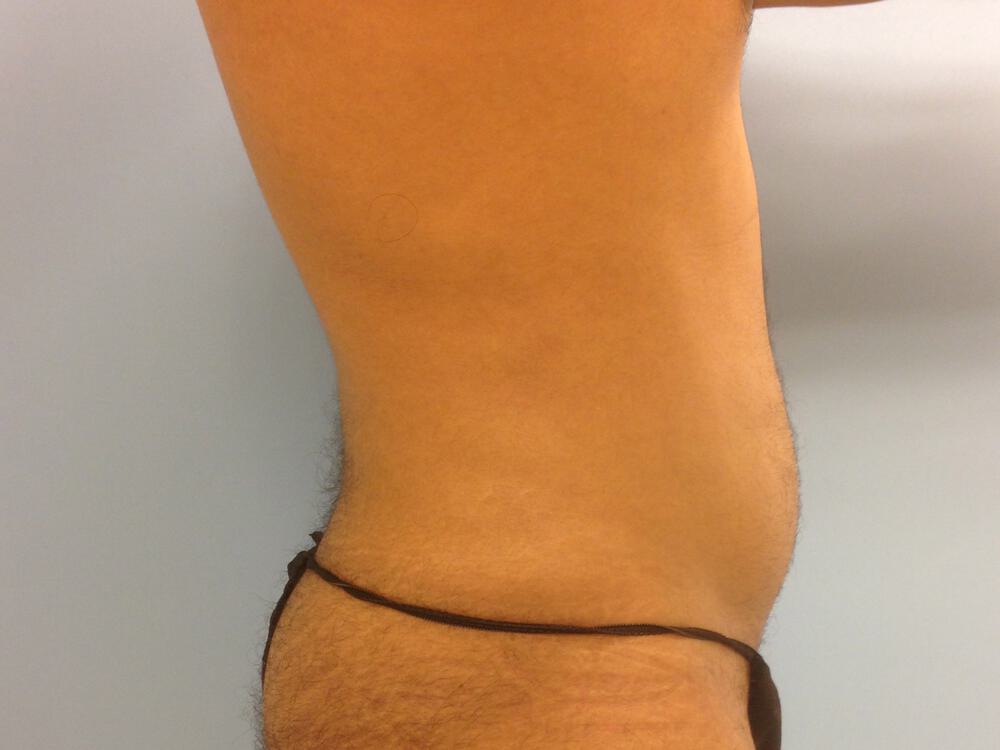 Male Liposuction Before & After Image