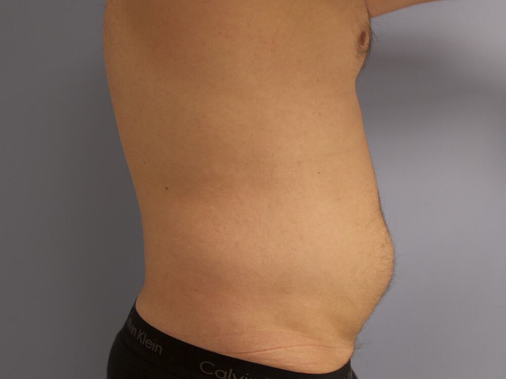 Male Liposuction Before & After Image