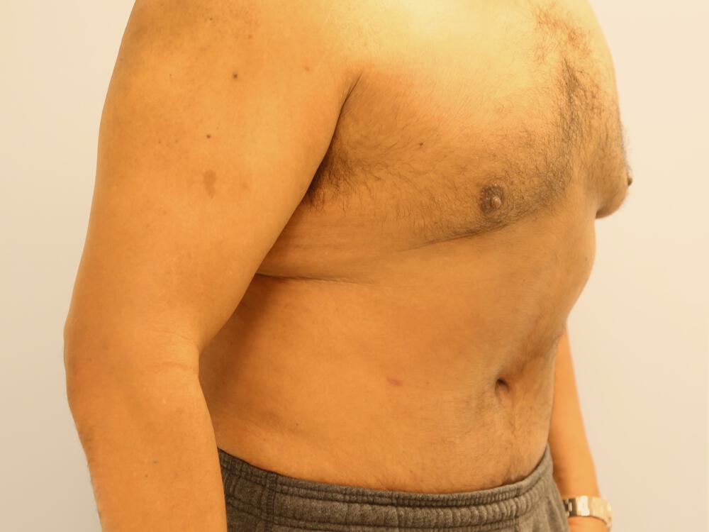 Male Tummy Tuck Before & After Image