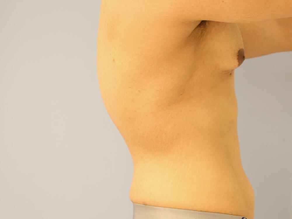 Male Tummy Tuck Before & After Image