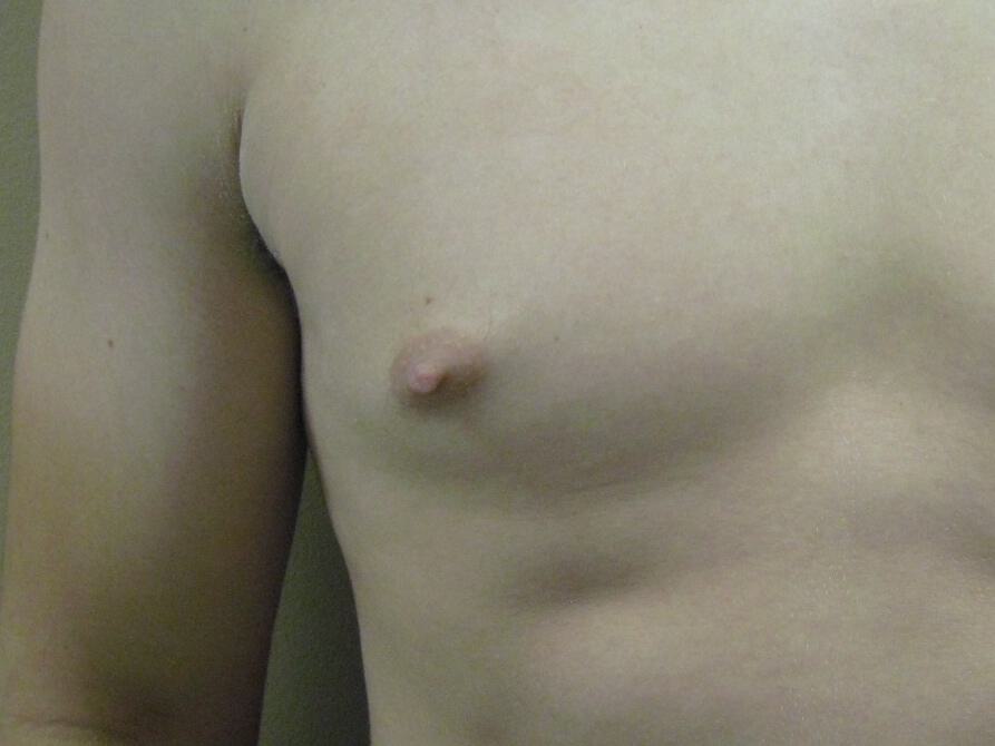 Male Nipple Reduction Before & After Image