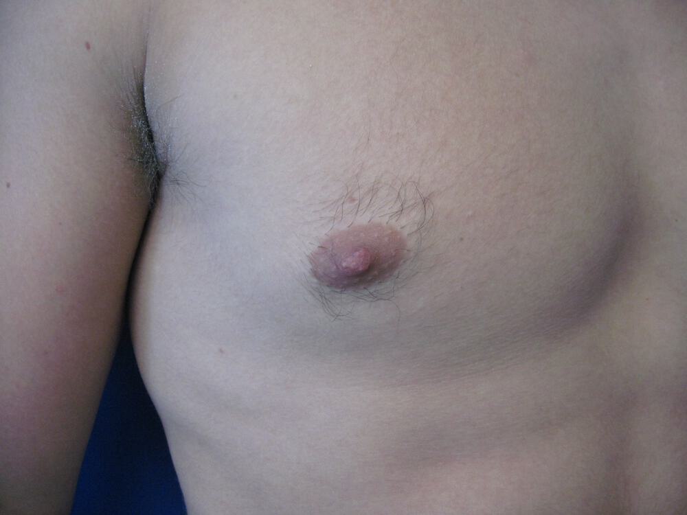 Male Nipple Reduction Before & After Image