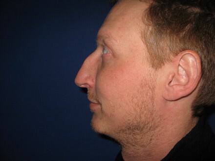 Male Rhinoplasty Before & After Image