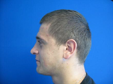 Male Rhinoplasty Before & After Image