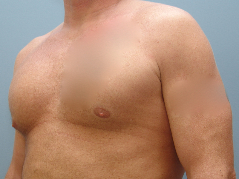 Pectoral Implants Before & After Image