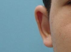 Male Prominent Ears Before & After Image