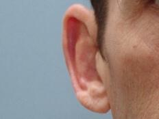 Male Prominent Ears Before & After Image