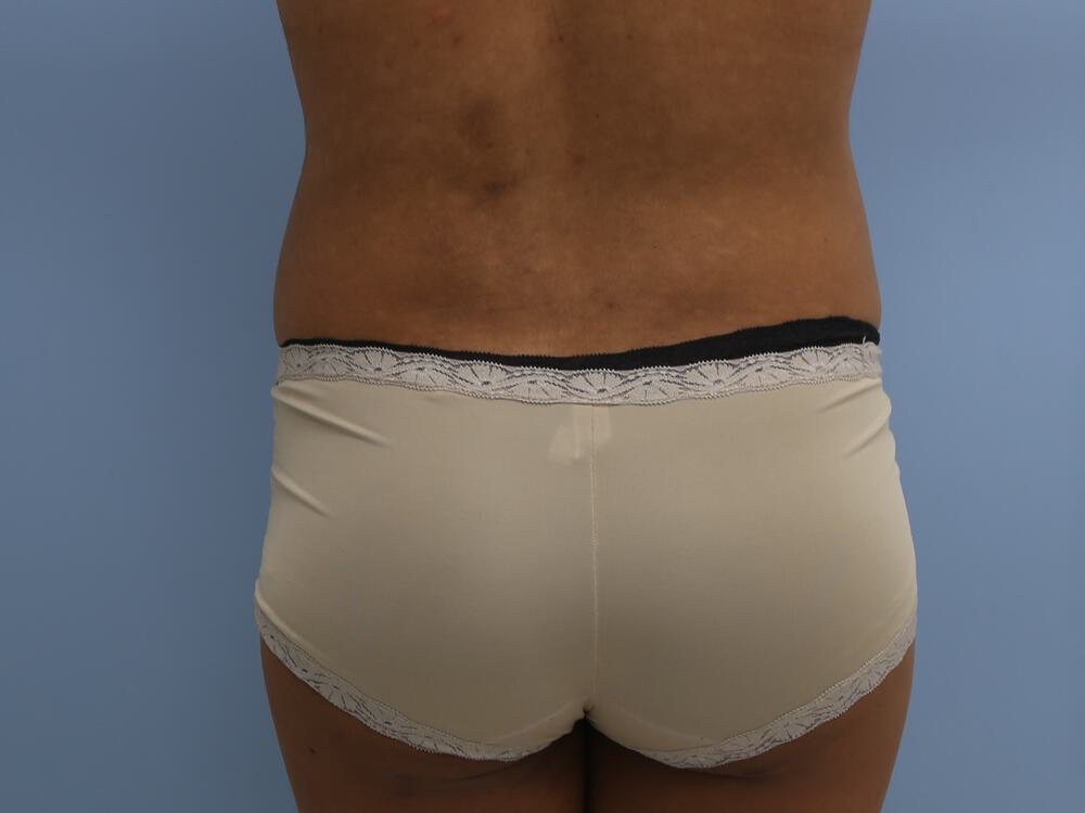 Butt Augmentation Before & After Image