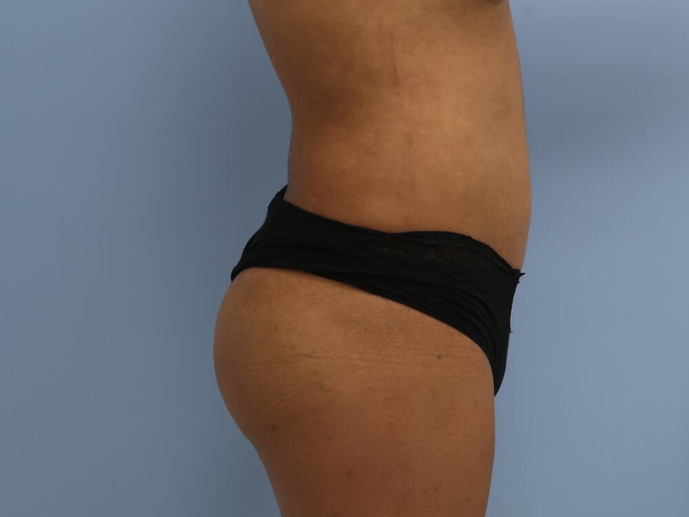 Butt Augmentation Before & After Image