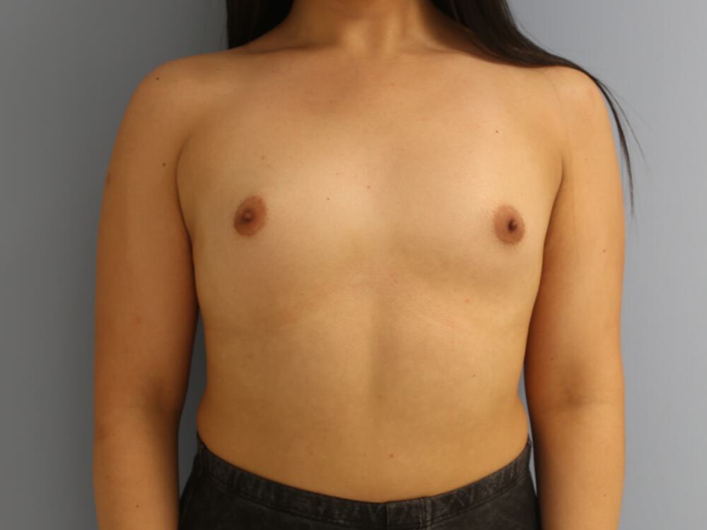 M-F Breast Augmentation Before & After Image