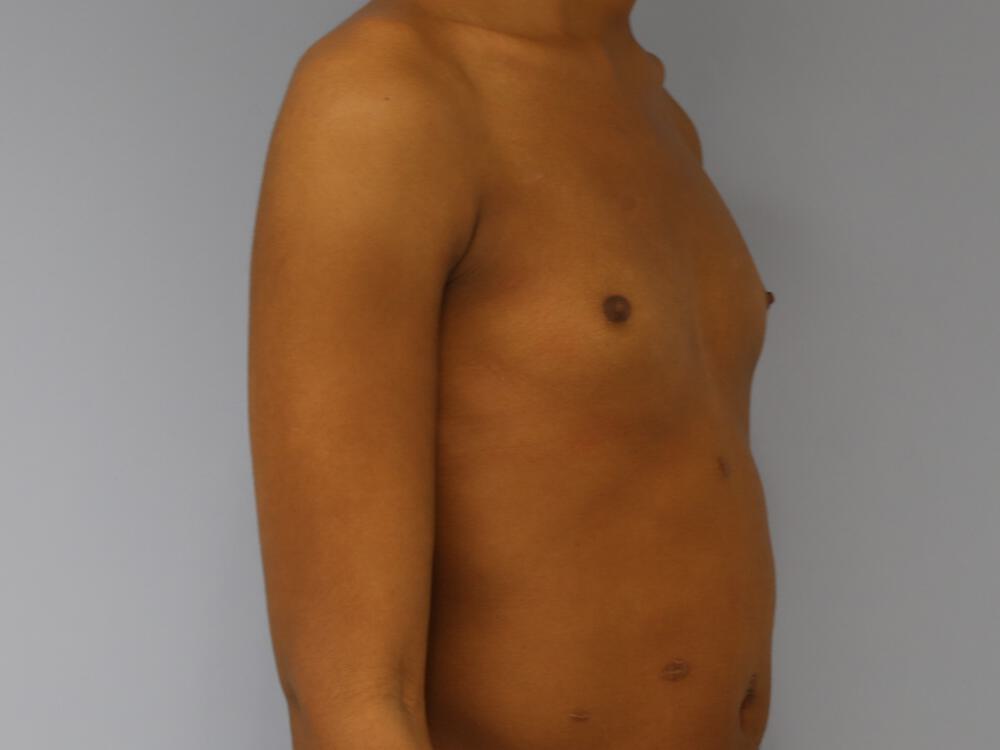M-F Breast Augmentation Before & After Image